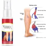 Eelhoe Varicose Veins Spray