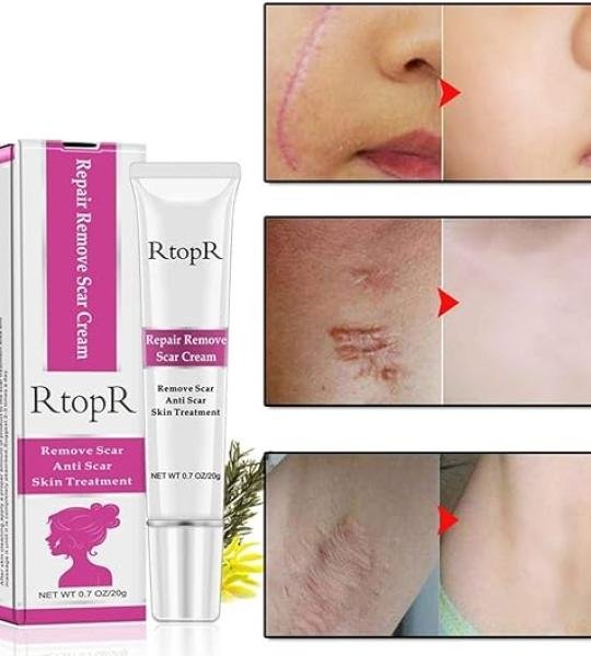 Rtopr Acne Scar Removal Cream